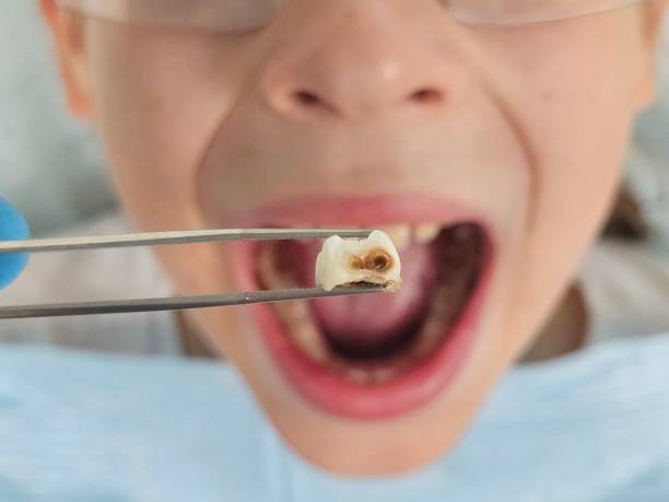 Best Emergency Tooth Extraction in Geneva, FL