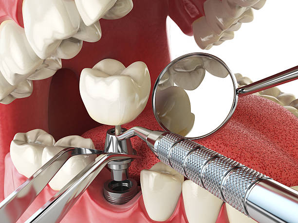 Best Emergency Wisdom Teeth Removal in Geneva, FL